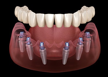 Illustration of implant dentures