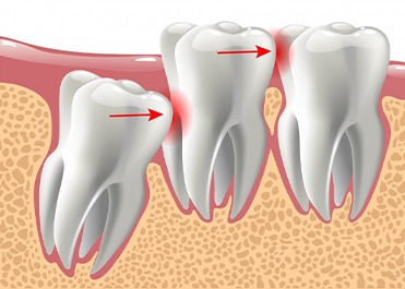 Illustration of impacted wisdom tooth