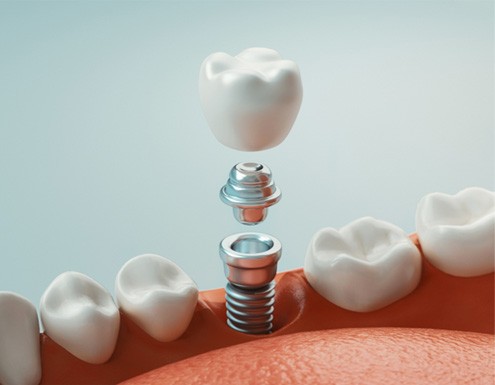 a graphic illustration depicting an implant crown