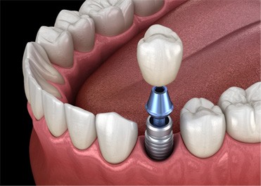 a computer illustration of an implant crown