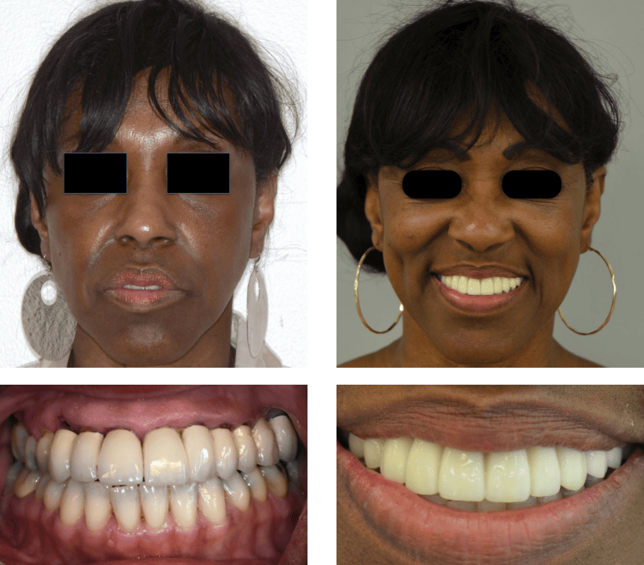 Close up of smile before and after straightening teeth and replacing a missing tooth