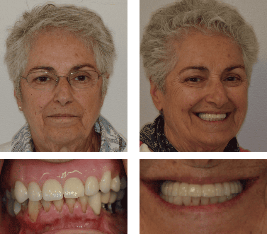 Close up of mouth before and after replacing a missing upper tooth