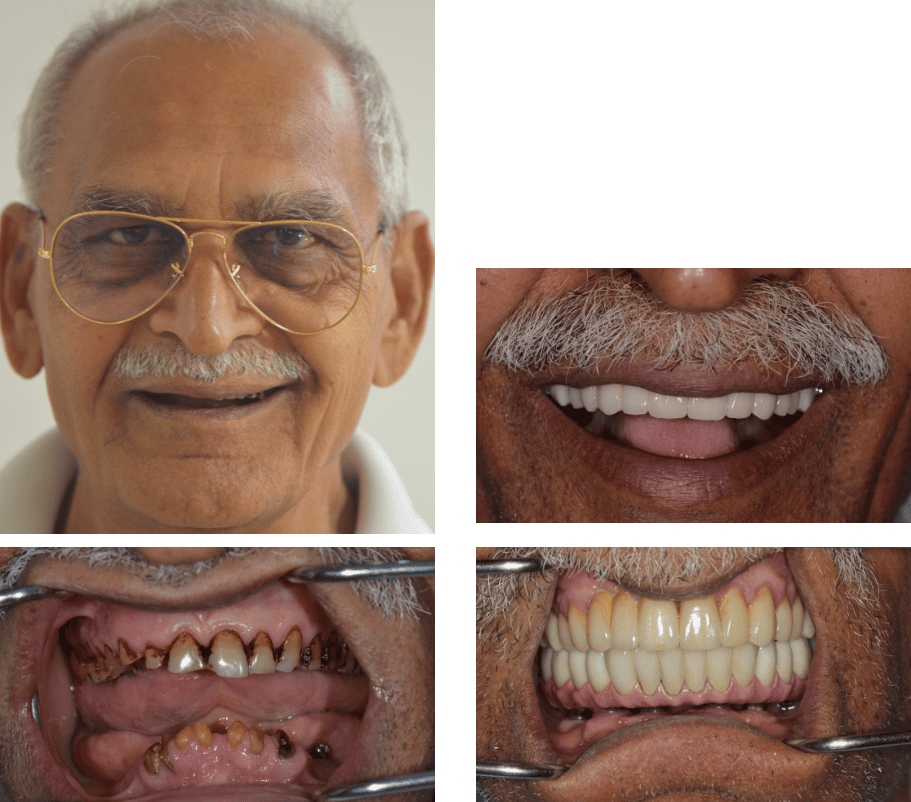 Smile before and after straightening and whitening teeth