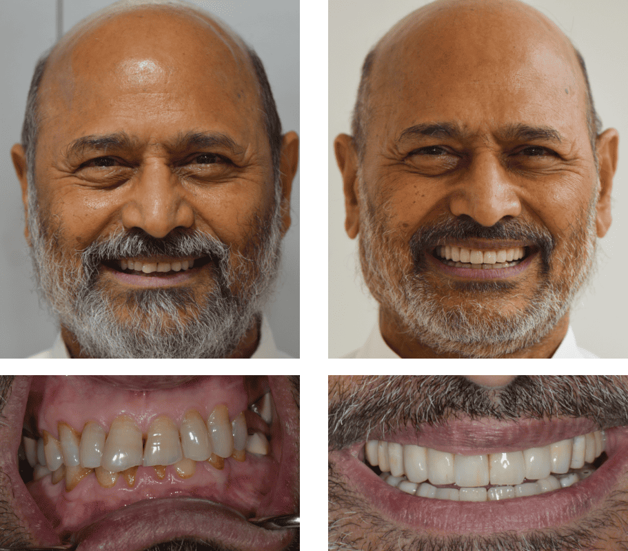 Man with short facial hair smiling before and after whitening teeth and replacing a missing one