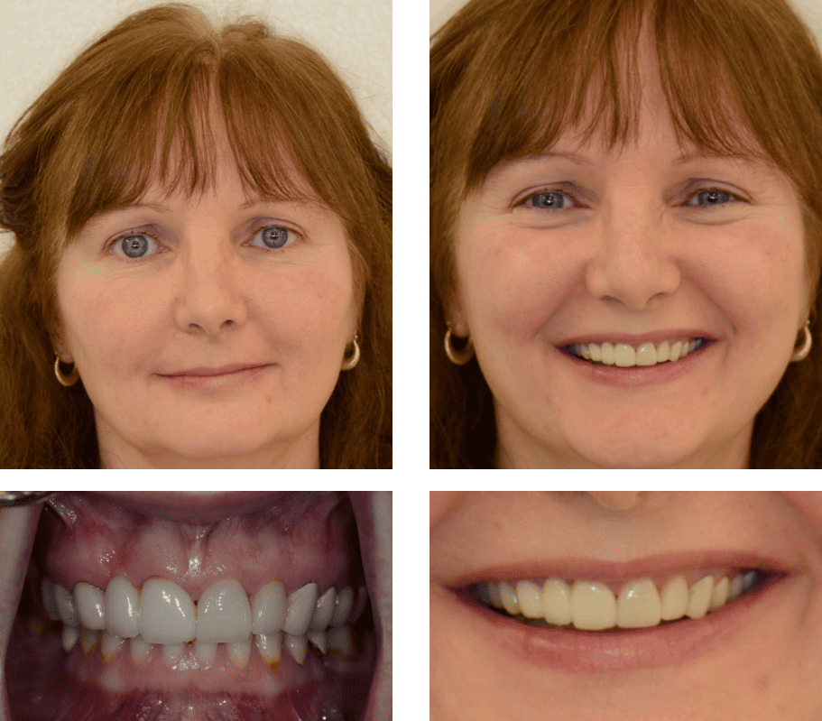 Man smiling before and after replacing upper arch of teeth