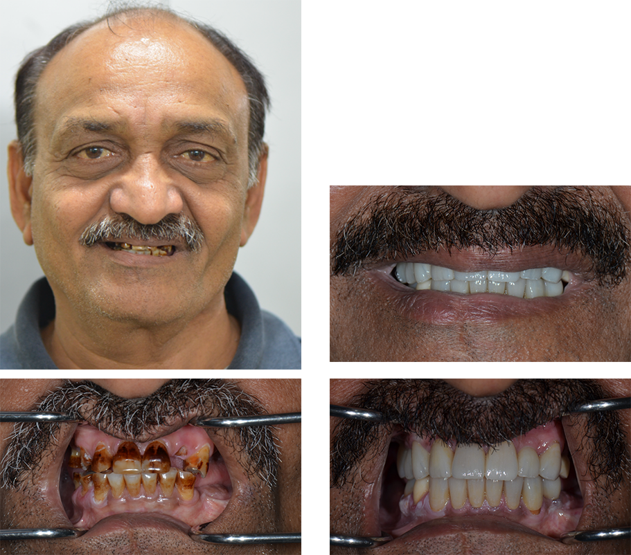 Close up of upper row of teeth before and after replacing a missing tooth