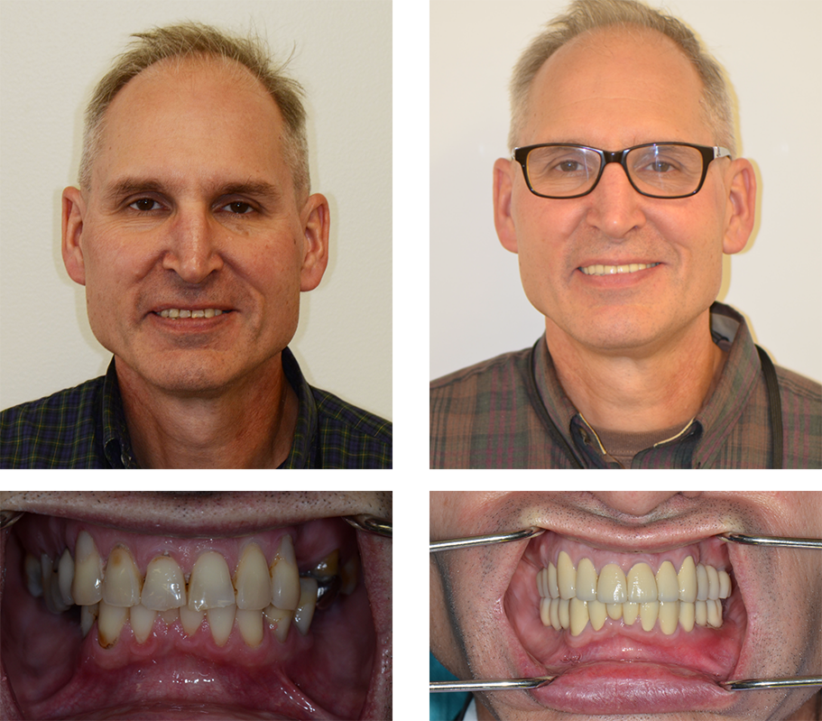 Man smiling before and after brightening teeth and replacing a missing one