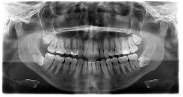 An X-ray image of impacted wisdom teeth.